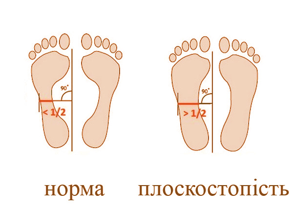 як виявити плоскостопість лікування